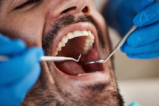Best Knocked-Out Tooth (Avulsed Tooth) Treatment in Shenandoah Heights, PA